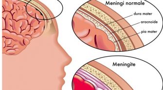 Meningite